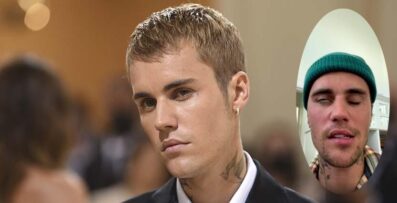 Justin Bieber riskerar bli helt vanställd för livet